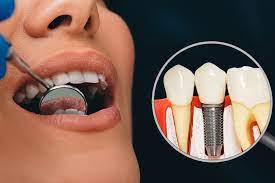 why no dairy after dental implant