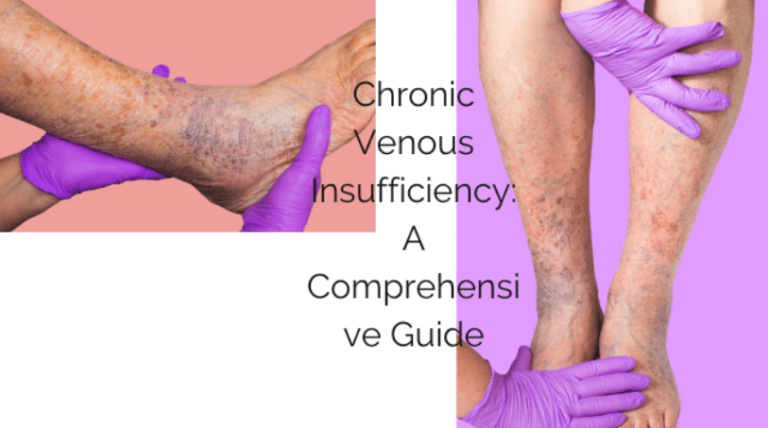 Chronic Venous Insufficiency: A Comprehensive Guide