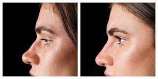 Nose Dermal Fillers: Enhancing Your Look with Confidence
